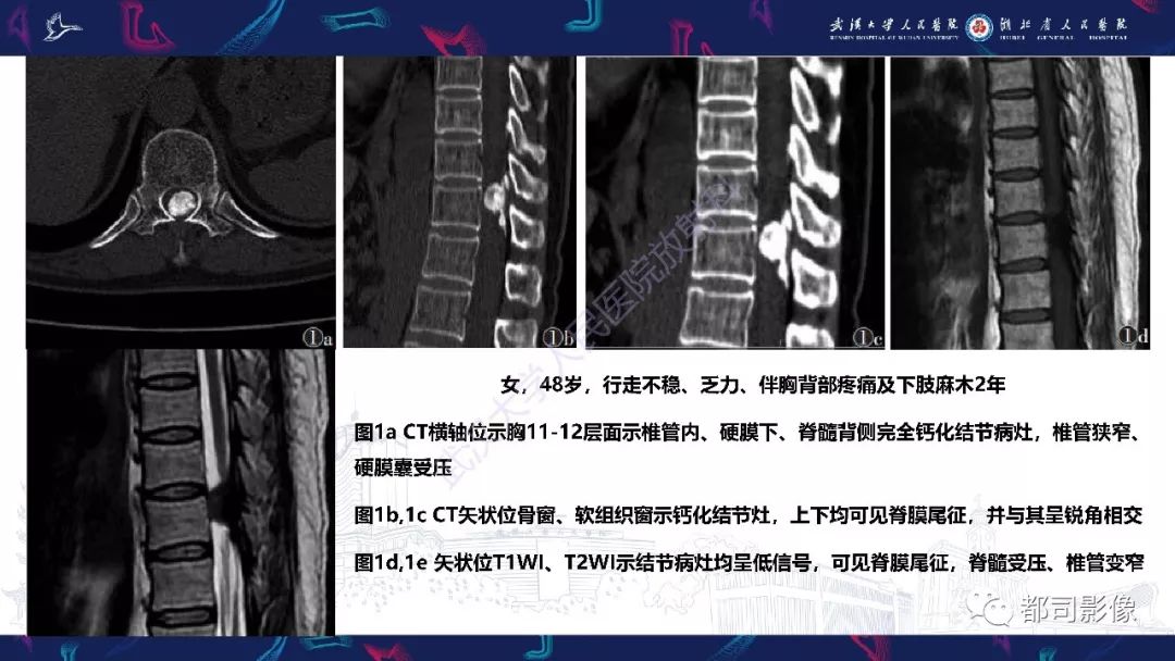 【病例】少见脊膜瘤影像诊断