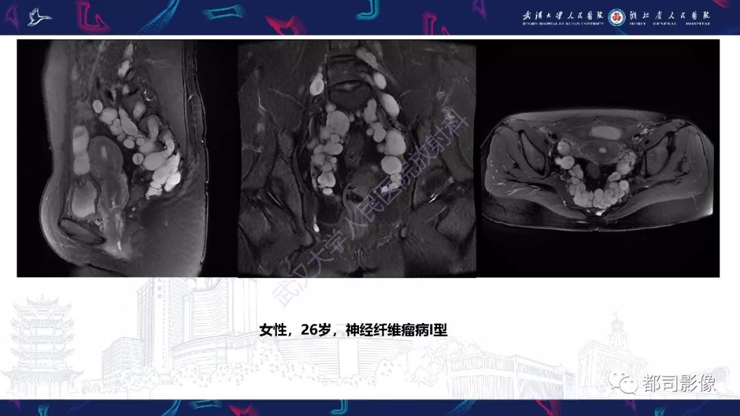 【病例】少见脊膜瘤影像诊断