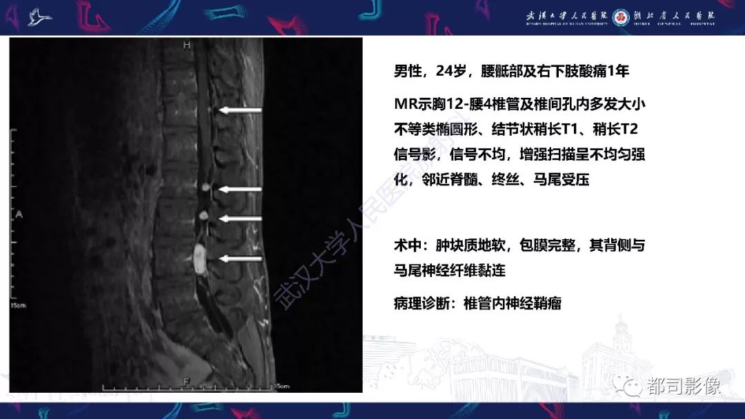【病例】少见脊膜瘤影像诊断