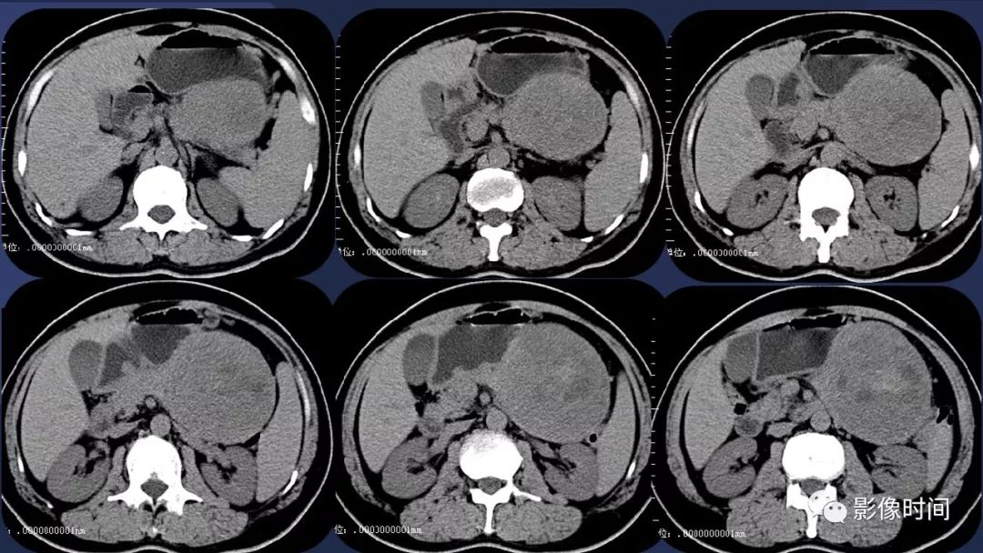 【病例】胰腺巨大占位(腺泡细胞癌)1例CT影像表现 【病例】胰腺巨大占位(腺泡细胞癌)1例CT影像表现