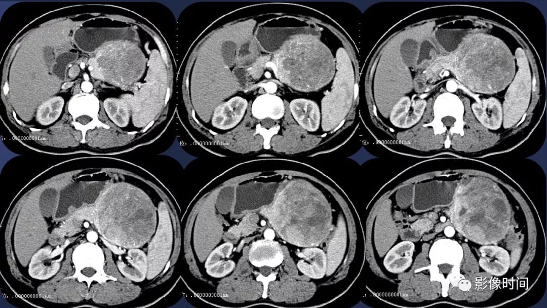 【病例】胰腺巨大占位(腺泡细胞癌)1例CT影像表现 【病例】胰腺巨大占位(腺泡细胞癌)1例CT影像表现