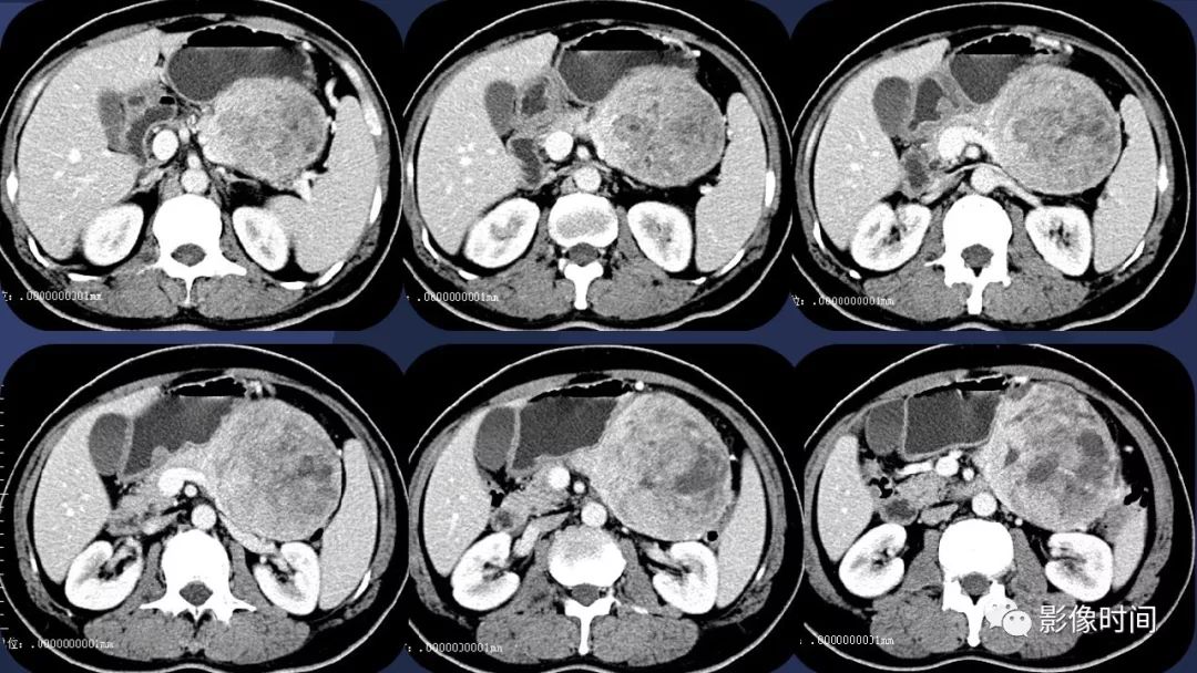 【病例】胰腺巨大占位(腺泡细胞癌)1例CT影像表现 【病例】胰腺巨大占位(腺泡细胞癌)1例CT影像表现