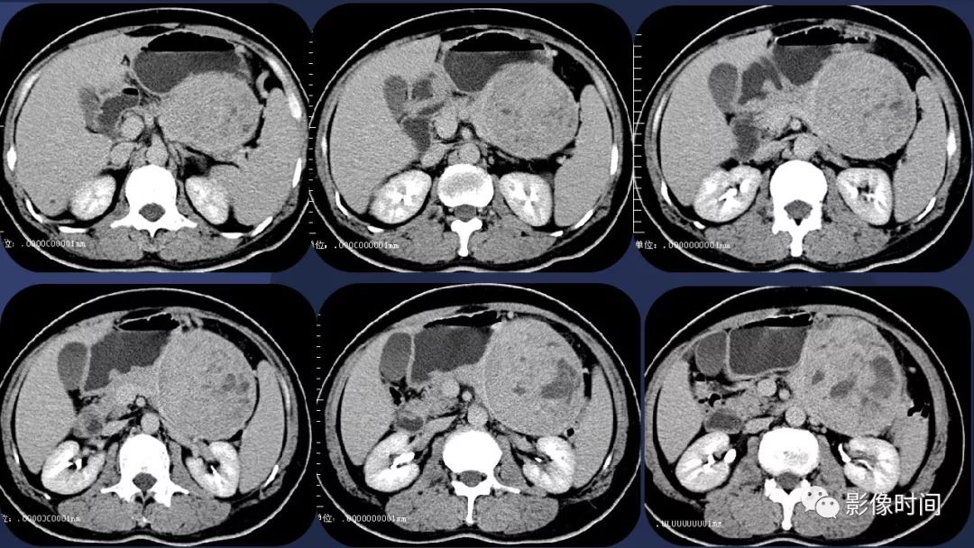 【病例】胰腺巨大占位(腺泡细胞癌)1例CT影像表现 【病例】胰腺巨大占位(腺泡细胞癌)1例CT影像表现