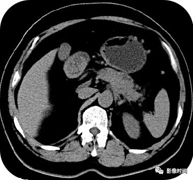 【病例】胰腺巨大占位(腺泡细胞癌)1例CT影像表现 【病例】胰腺巨大占位(腺泡细胞癌)1例CT影像表现
