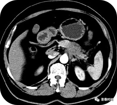 【病例】胰腺巨大占位(腺泡细胞癌)1例CT影像表现 【病例】胰腺巨大占位(腺泡细胞癌)1例CT影像表现