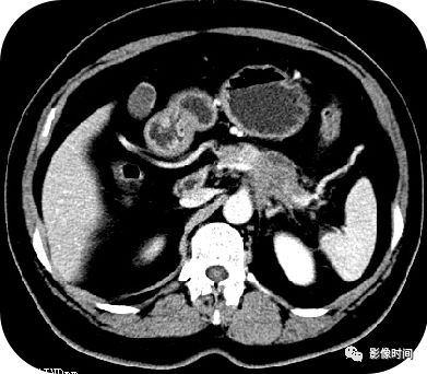 【病例】胰腺巨大占位(腺泡细胞癌)1例CT影像表现 【病例】胰腺巨大占位(腺泡细胞癌)1例CT影像表现