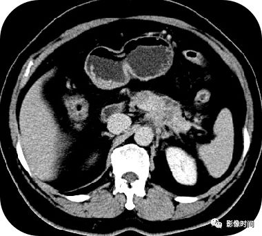 【病例】胰腺巨大占位(腺泡细胞癌)1例CT影像表现 【病例】胰腺巨大占位(腺泡细胞癌)1例CT影像表现