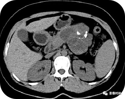 【病例】胰腺巨大占位(腺泡细胞癌)1例CT影像表现 【病例】胰腺巨大占位(腺泡细胞癌)1例CT影像表现