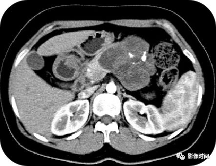 【病例】胰腺巨大占位(腺泡细胞癌)1例CT影像表现 【病例】胰腺巨大占位(腺泡细胞癌)1例CT影像表现