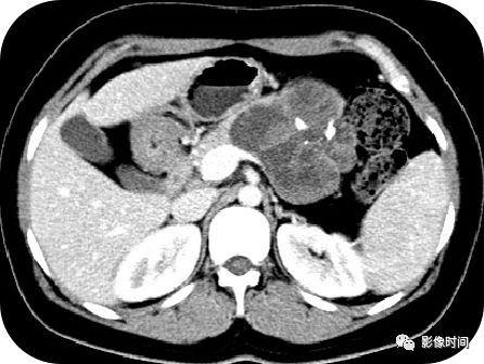 【病例】胰腺巨大占位(腺泡细胞癌)1例CT影像表现 【病例】胰腺巨大占位(腺泡细胞癌)1例CT影像表现