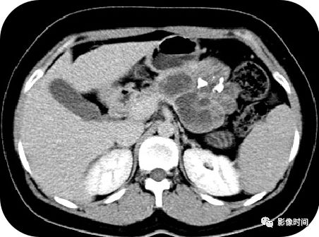 【病例】胰腺巨大占位(腺泡细胞癌)1例CT影像表现 【病例】胰腺巨大占位(腺泡细胞癌)1例CT影像表现