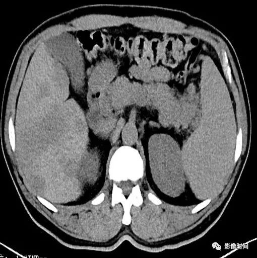 【病例】胰腺巨大占位(腺泡细胞癌)1例CT影像表现 【病例】胰腺巨大占位(腺泡细胞癌)1例CT影像表现
