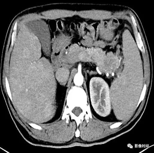 【病例】胰腺巨大占位(腺泡细胞癌)1例CT影像表现 【病例】胰腺巨大占位(腺泡细胞癌)1例CT影像表现