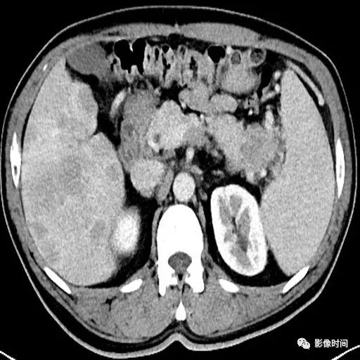 【病例】胰腺巨大占位(腺泡细胞癌)1例CT影像表现 【病例】胰腺巨大占位(腺泡细胞癌)1例CT影像表现
