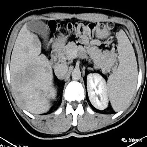 【病例】胰腺巨大占位(腺泡细胞癌)1例CT影像表现 【病例】胰腺巨大占位(腺泡细胞癌)1例CT影像表现