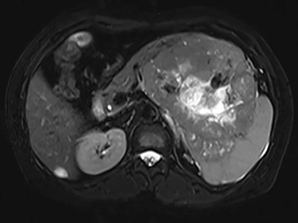 【病例】胰腺腺泡细胞癌1例MR影像表现