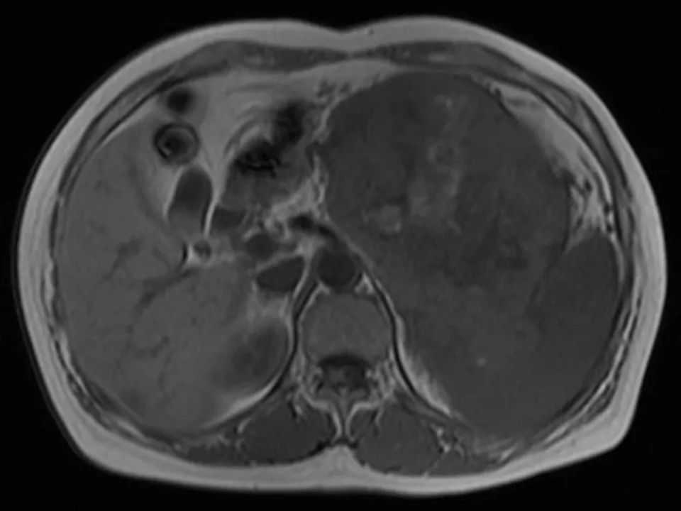 【病例】胰腺腺泡细胞癌1例MR影像表现 【病例】胰腺腺泡细胞癌1例MR影像表现