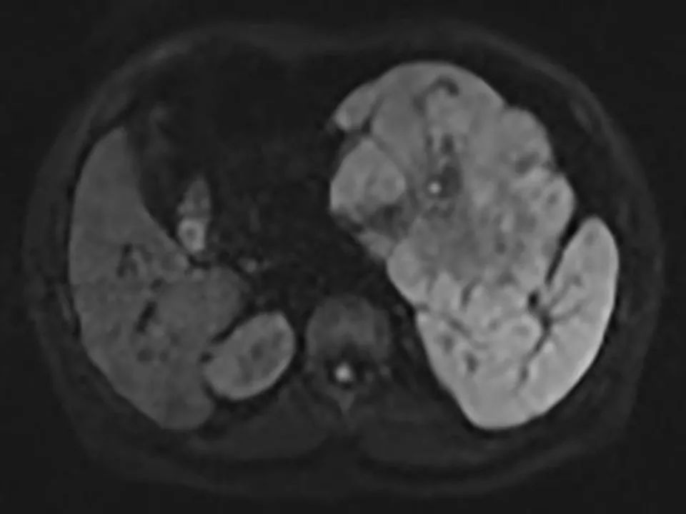 【病例】胰腺腺泡细胞癌1例MR影像表现 【病例】胰腺腺泡细胞癌1例MR影像表现
