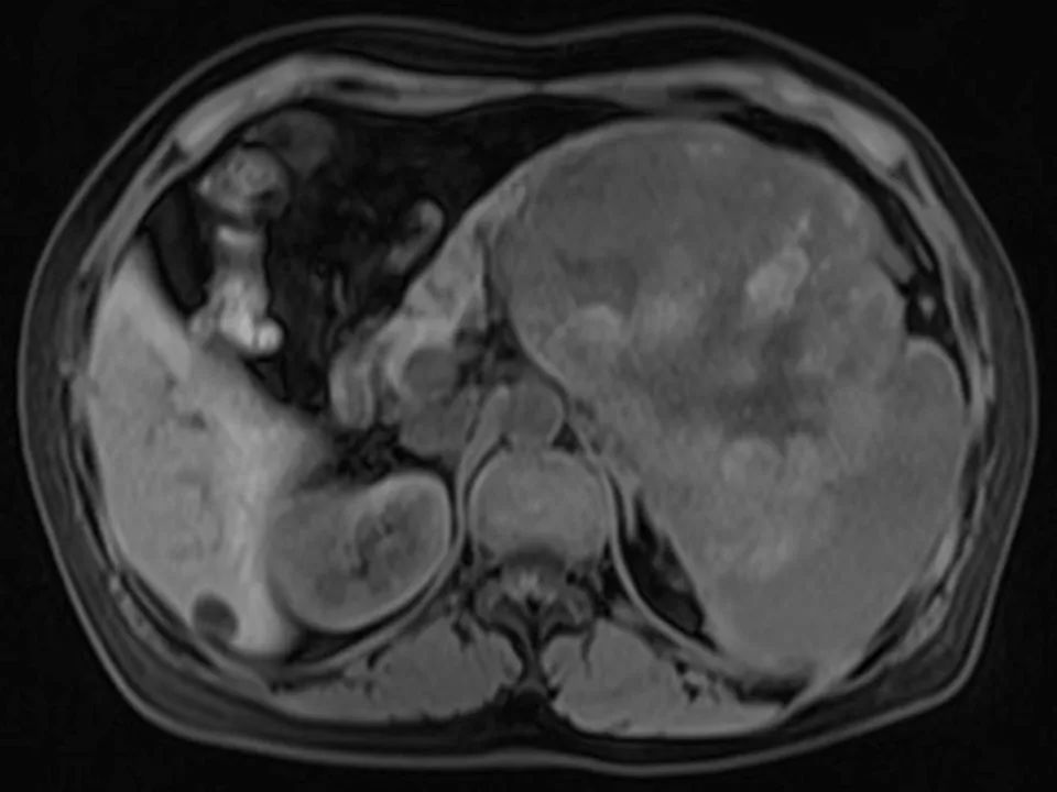 【病例】胰腺腺泡细胞癌1例MR影像表现 【病例】胰腺腺泡细胞癌1例MR影像表现