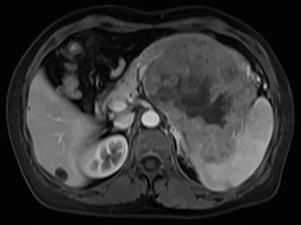 【病例】胰腺腺泡细胞癌1例MR影像表现 【病例】胰腺腺泡细胞癌1例MR影像表现