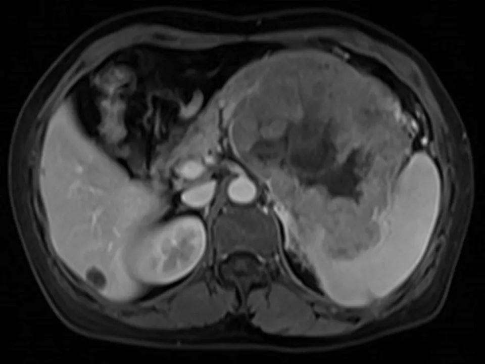 【病例】胰腺腺泡细胞癌1例MR影像表现 【病例】胰腺腺泡细胞癌1例MR影像表现