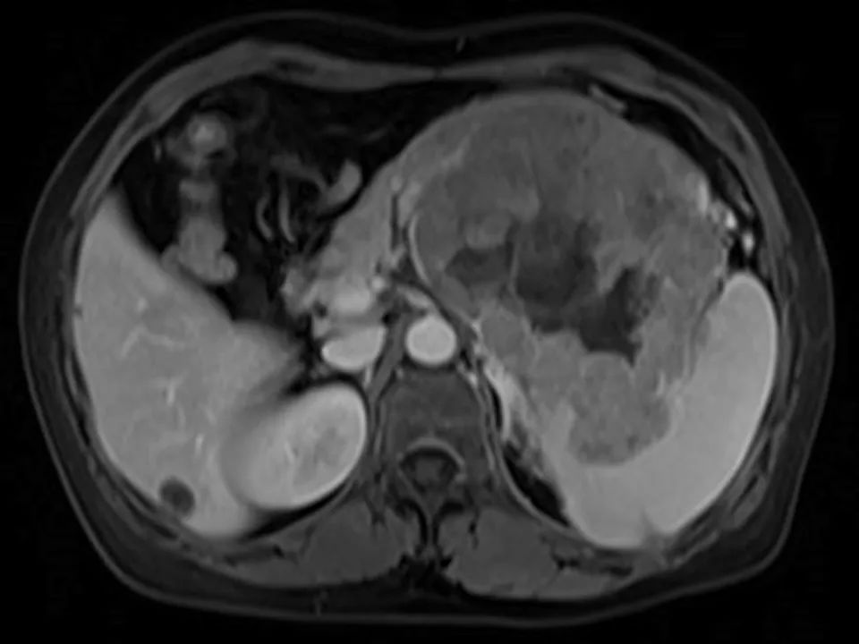 【病例】胰腺腺泡细胞癌1例MR影像表现 【病例】胰腺腺泡细胞癌1例MR影像表现