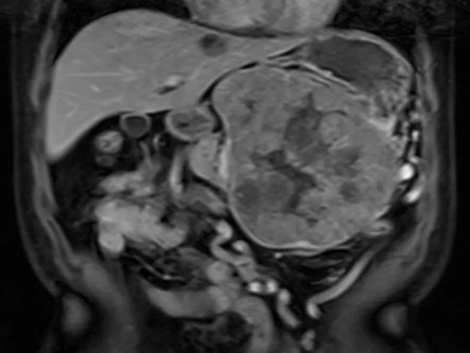 【病例】胰腺腺泡细胞癌1例MR影像表现 【病例】胰腺腺泡细胞癌1例MR影像表现