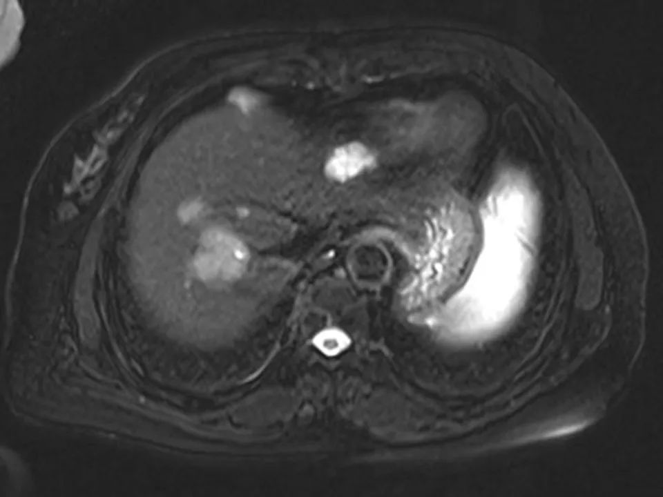 【病例】胰腺腺泡细胞癌1例MR影像表现 【病例】胰腺腺泡细胞癌1例MR影像表现