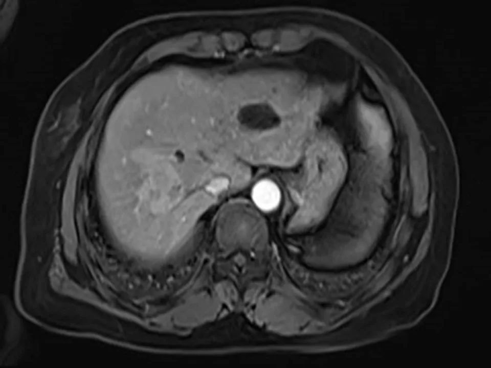 【病例】胰腺腺泡细胞癌1例MR影像表现 【病例】胰腺腺泡细胞癌1例MR影像表现