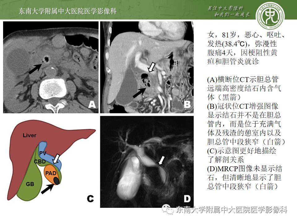 【病例】Lemmel's 综合征/十二指肠乳头旁憩室综合征