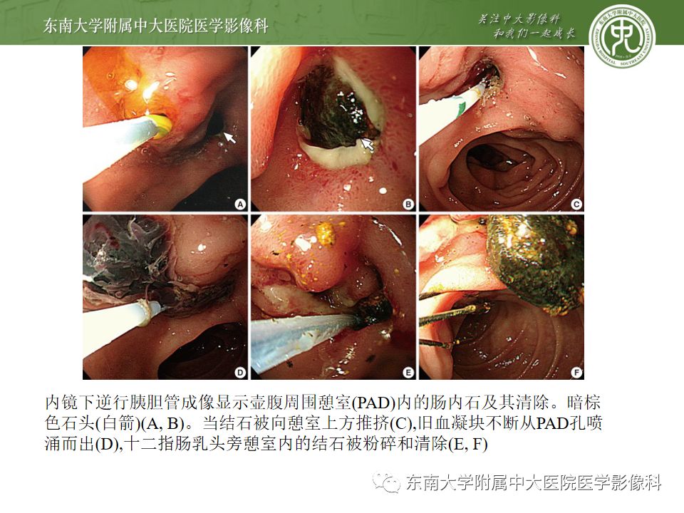 【病例】Lemmel's 综合征/十二指肠乳头旁憩室综合征