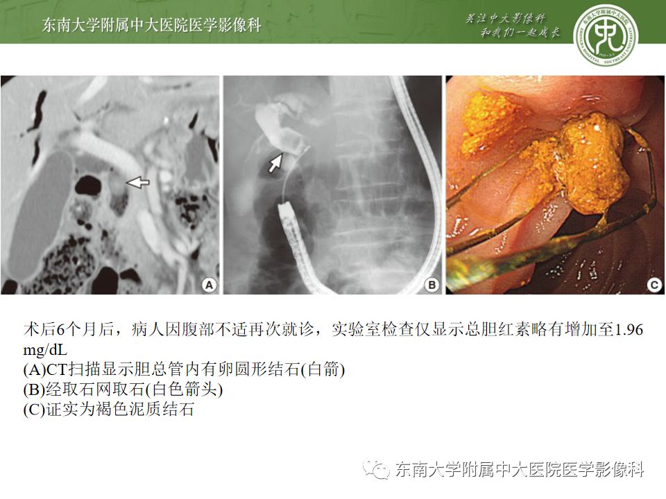 【病例】Lemmel's 综合征/十二指肠乳头旁憩室综合征