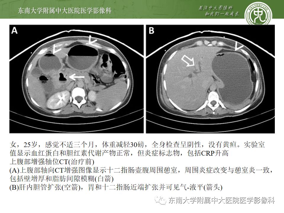 【病例】Lemmel's 综合征/十二指肠乳头旁憩室综合征