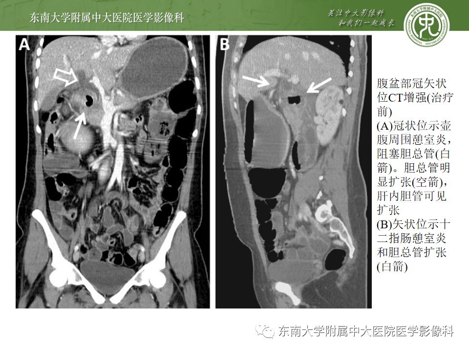 【病例】Lemmel's 综合征/十二指肠乳头旁憩室综合征