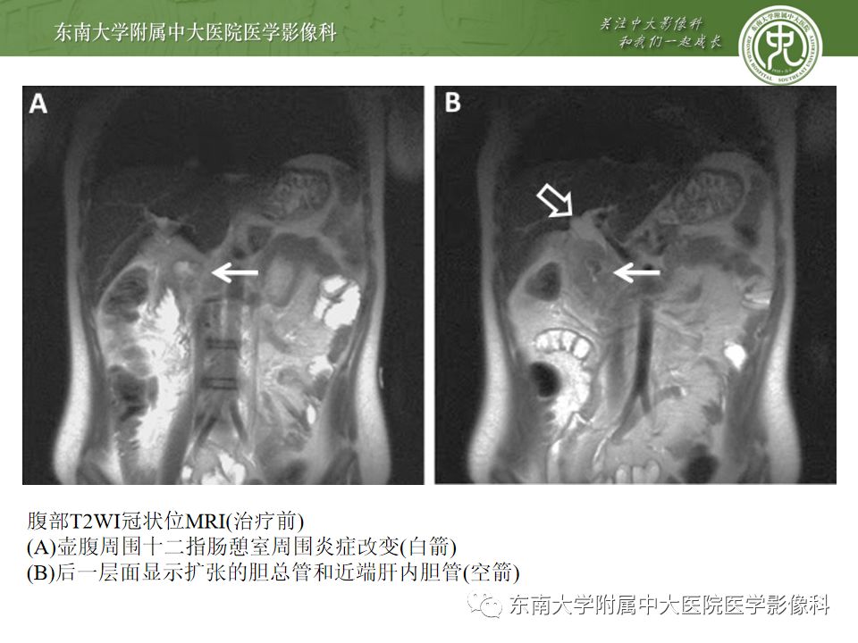 【病例】Lemmel's 综合征/十二指肠乳头旁憩室综合征