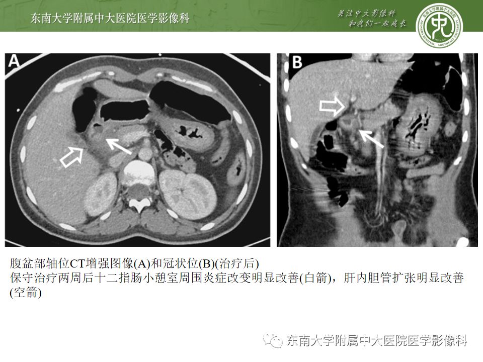 【病例】Lemmel's 综合征/十二指肠乳头旁憩室综合征