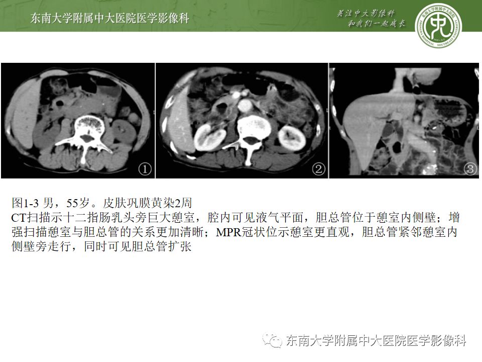 【病例】Lemmel's 综合征/十二指肠乳头旁憩室综合征