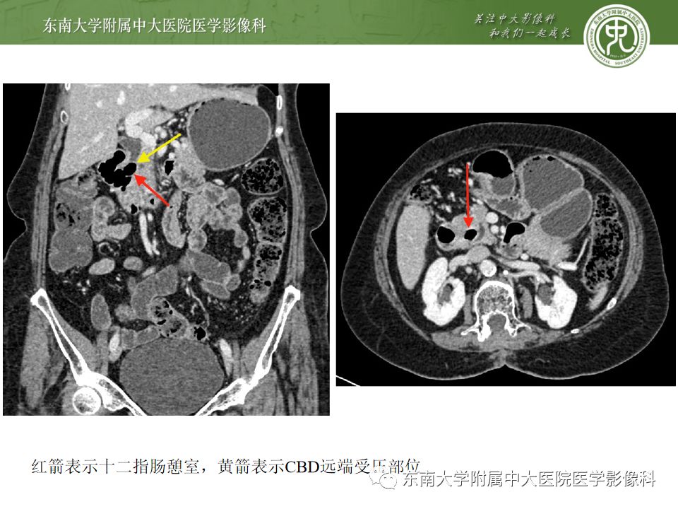 【病例】Lemmel's 综合征/十二指肠乳头旁憩室综合征