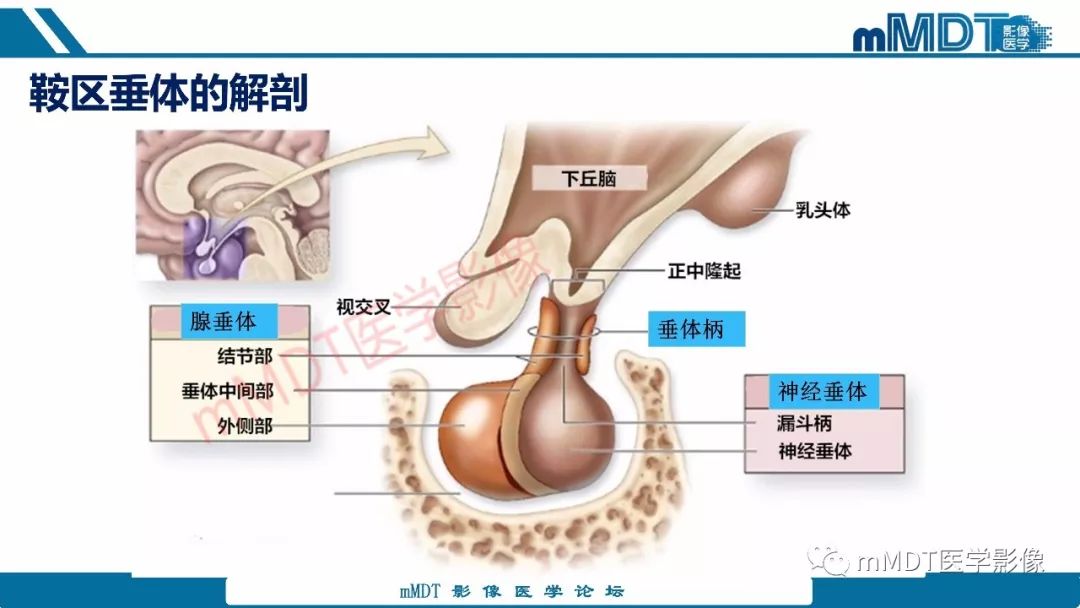 【PPT】蝶鞍、鞍上少见实性肿瘤影像表现及鉴别诊断