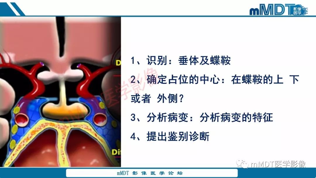 【PPT】蝶鞍、鞍上少见实性肿瘤影像表现及鉴别诊断
