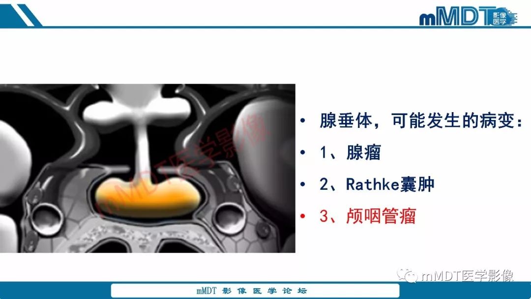 【PPT】蝶鞍、鞍上少见实性肿瘤影像表现及鉴别诊断