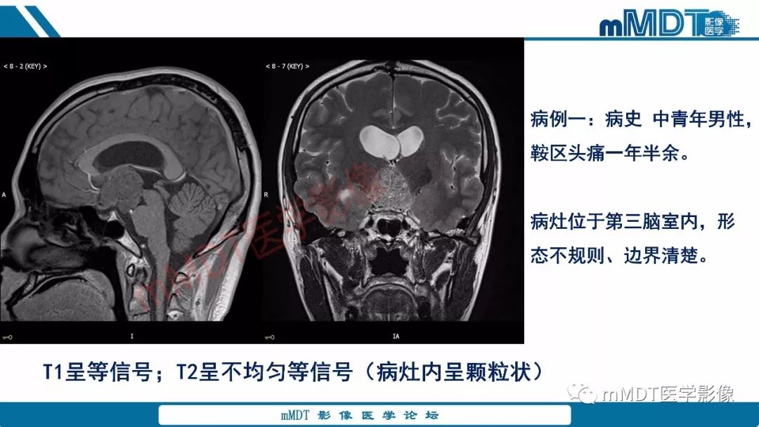 【PPT】蝶鞍、鞍上少见实性肿瘤影像表现及鉴别诊断