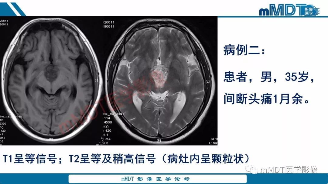 【PPT】蝶鞍、鞍上少见实性肿瘤影像表现及鉴别诊断