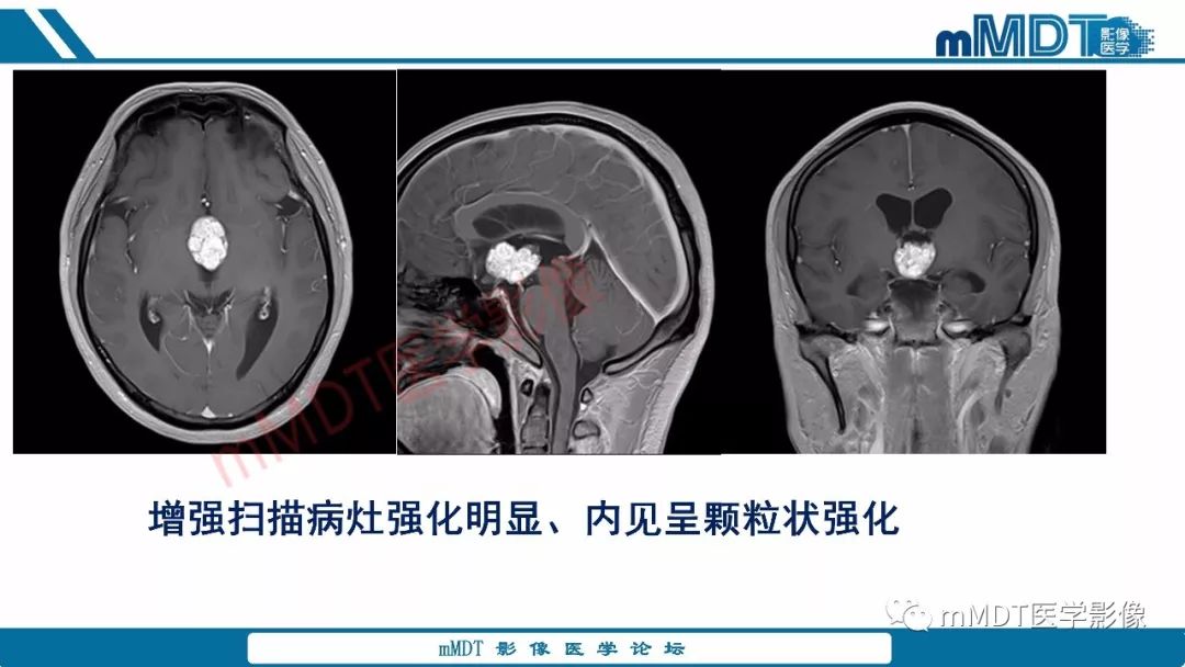 【PPT】蝶鞍、鞍上少见实性肿瘤影像表现及鉴别诊断