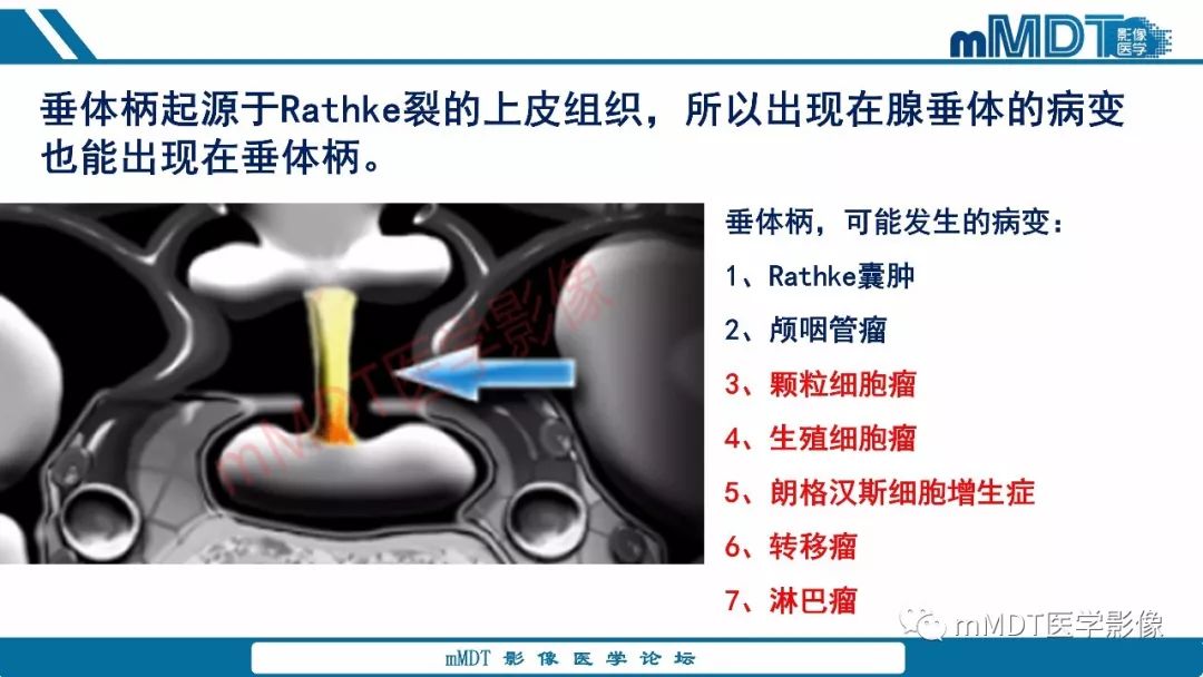 【PPT】蝶鞍、鞍上少见实性肿瘤影像表现及鉴别诊断