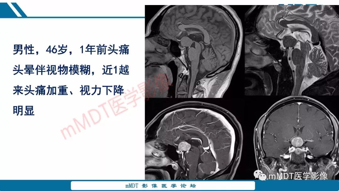 【PPT】蝶鞍、鞍上少见实性肿瘤影像表现及鉴别诊断