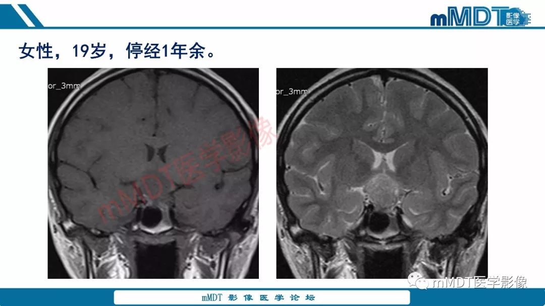 【PPT】蝶鞍、鞍上少见实性肿瘤影像表现及鉴别诊断