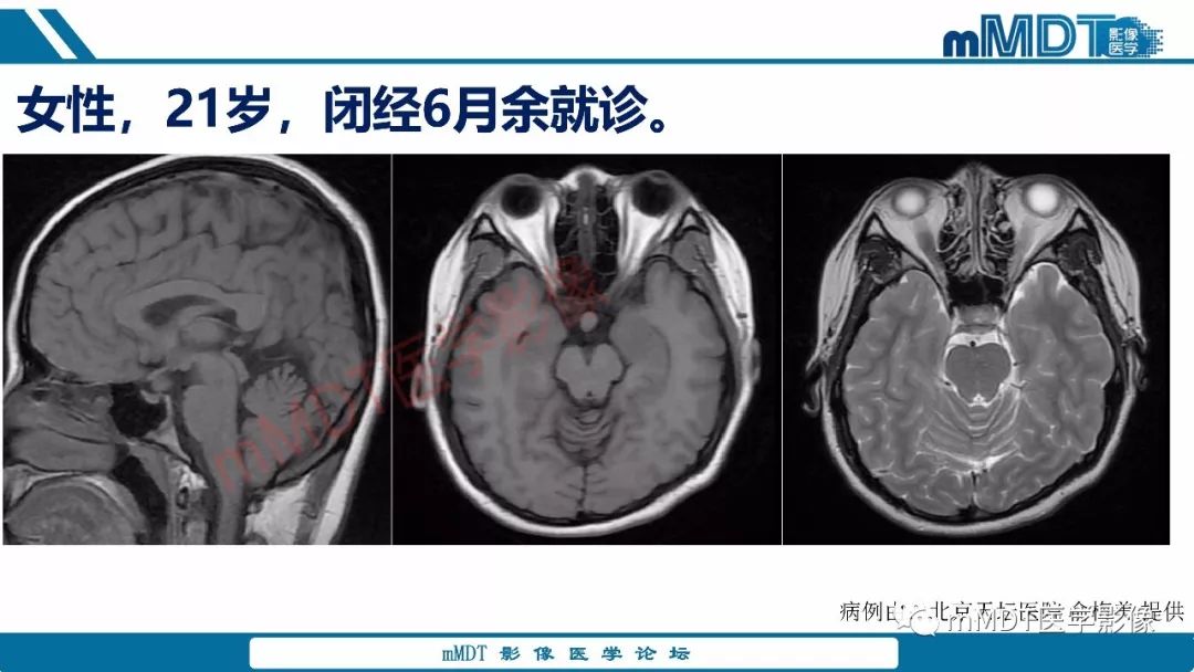 【PPT】蝶鞍、鞍上少见实性肿瘤影像表现及鉴别诊断
