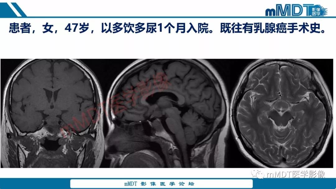 【PPT】蝶鞍、鞍上少见实性肿瘤影像表现及鉴别诊断