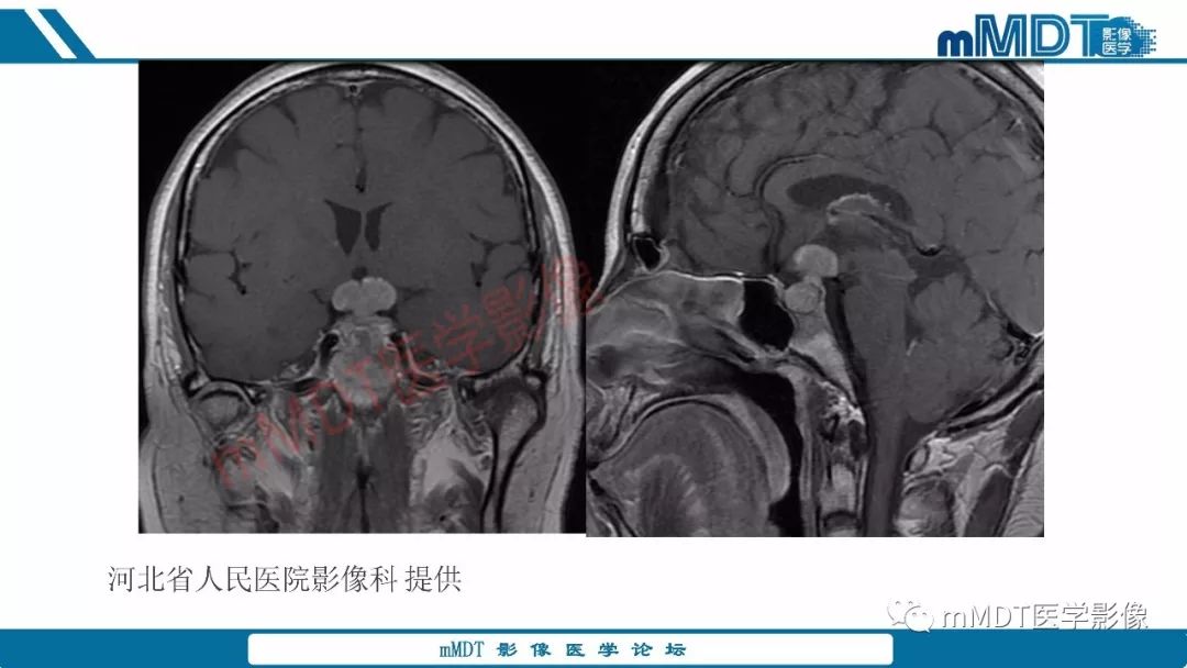 【PPT】蝶鞍、鞍上少见实性肿瘤影像表现及鉴别诊断